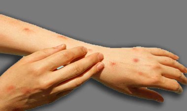 मंकीपॉक्स की भारत में एंट्री के बाद एक्शन में स्वास्थ्य मंत्रालय, सभी राज्यों को जारी की एडवाइजरी, पढ़ें निर्देश