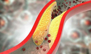 Cholesterol: नसों में कोलेस्ट्रॉल जमने का ये होता है सबसे बड़ा संकेत, इग्नोर करना पड़ सकता है भारी