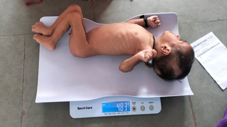 गंभीर कुपोषित प्रशांत पूर्ण रूप से हुआ स्वस्थ