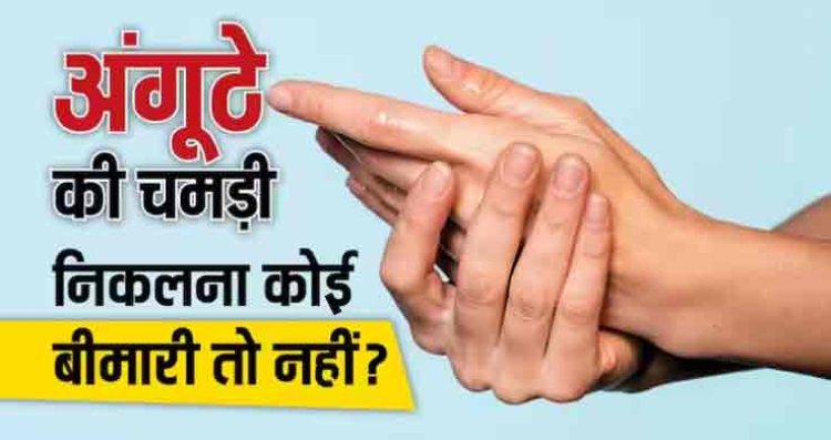 क्या आपके भी सर्दी में अंगूठे के पास से उतरती है ड्राई स्किन, ऐसे करें इलाज